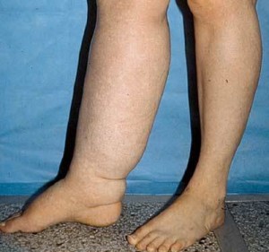 lymphedema-300x281